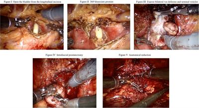 Efficacy of the transvesical approach for robotic-assisted radical prostatectomy via a bladder neck and prostate combined longitudinal incision for the treatment of localized prostate cancer